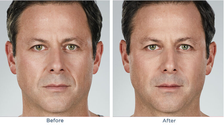 Juvederm
