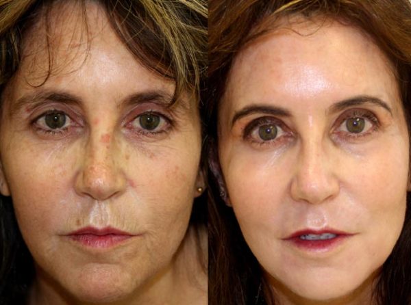 Laser Face Lift