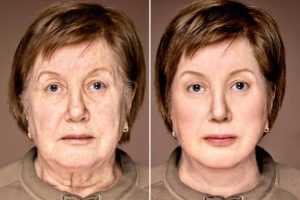 Facelift before and after