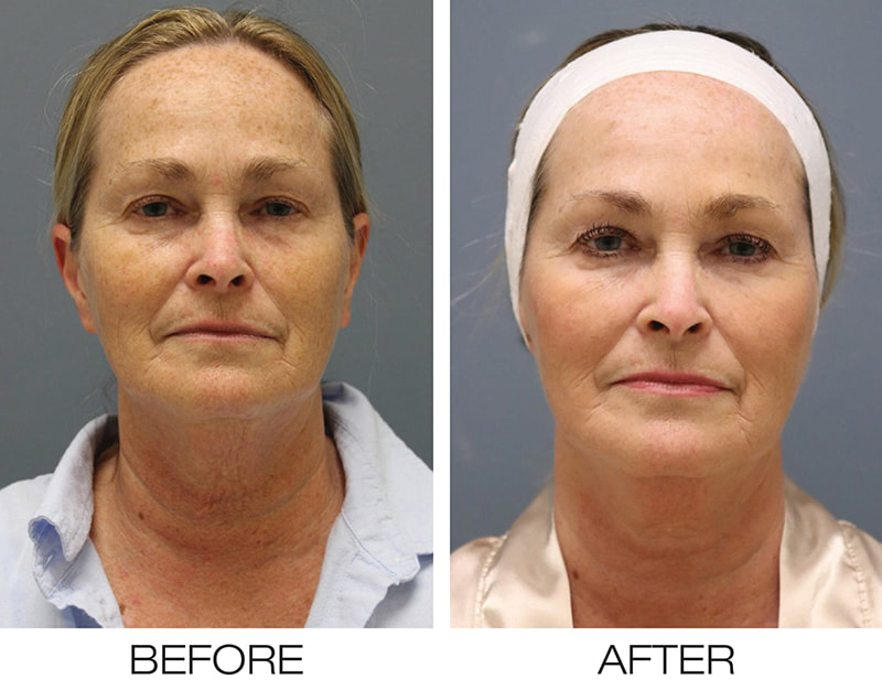Pixel8 rf microneedling