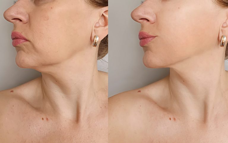 Facial threading