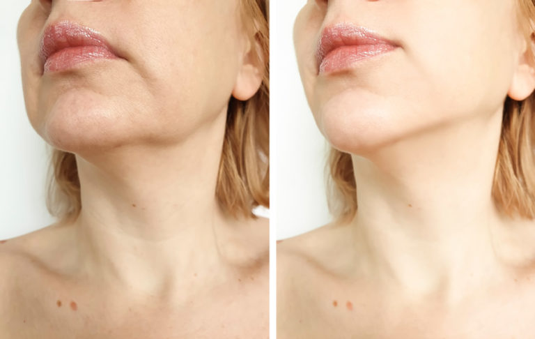Laser skin tightening near me