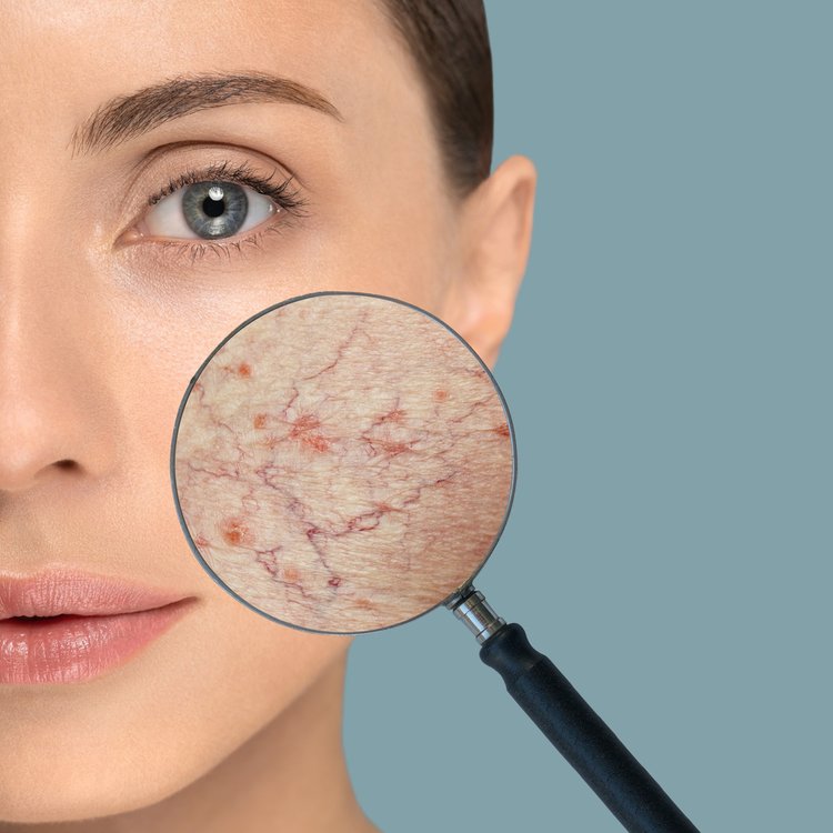 Spider veins on face treatment