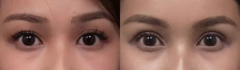 Double eye lid surgery