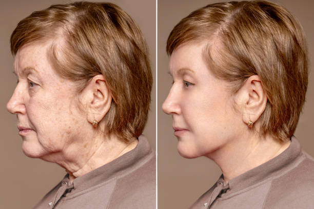 Facelift before and after
