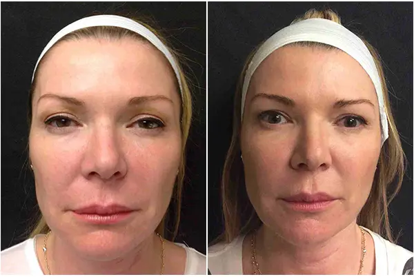 Facial threading