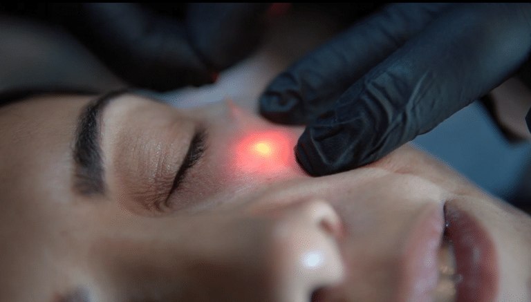 Endolift Laser