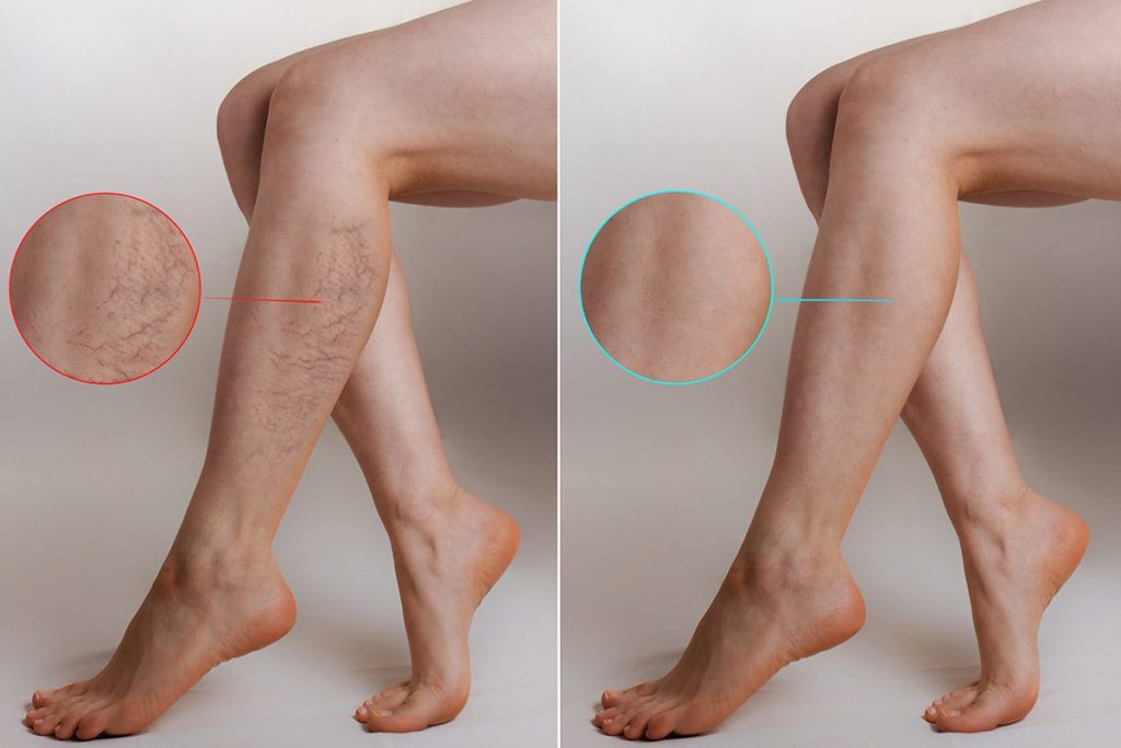 laser vein removal near me