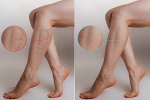 laser vein removal near me