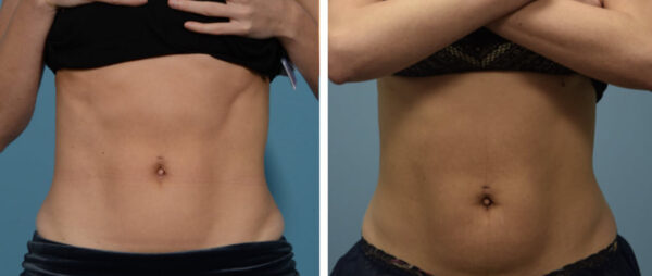 Body Sculpting