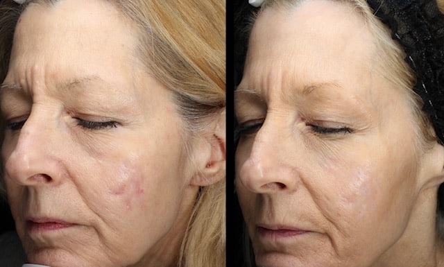 Fraxel laser
