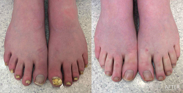 Toenail Fungus Treatment