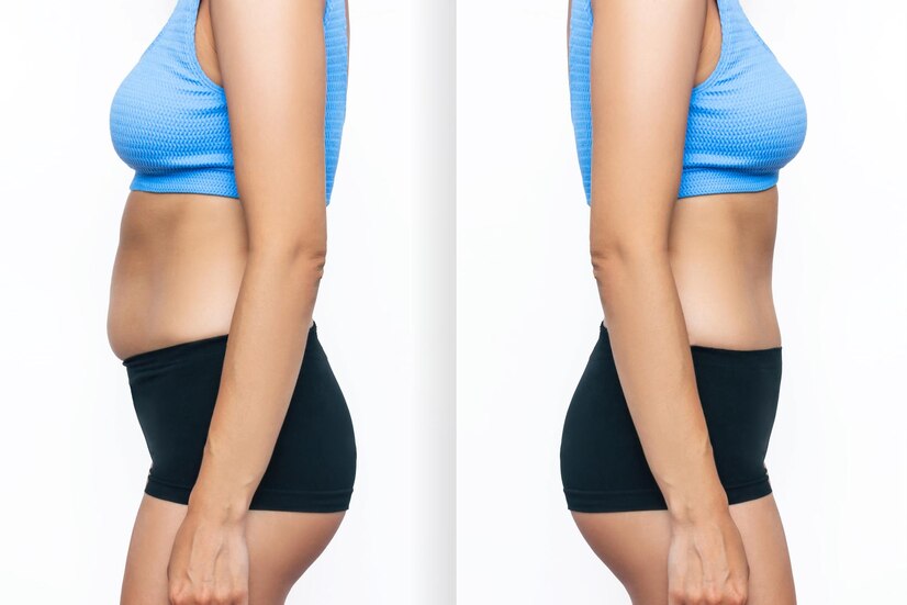 Liposuction Before And After