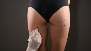BBL Surgery