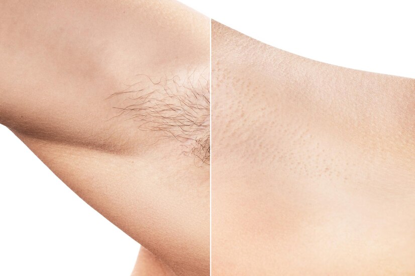 AB Linea Laser Hair Removal