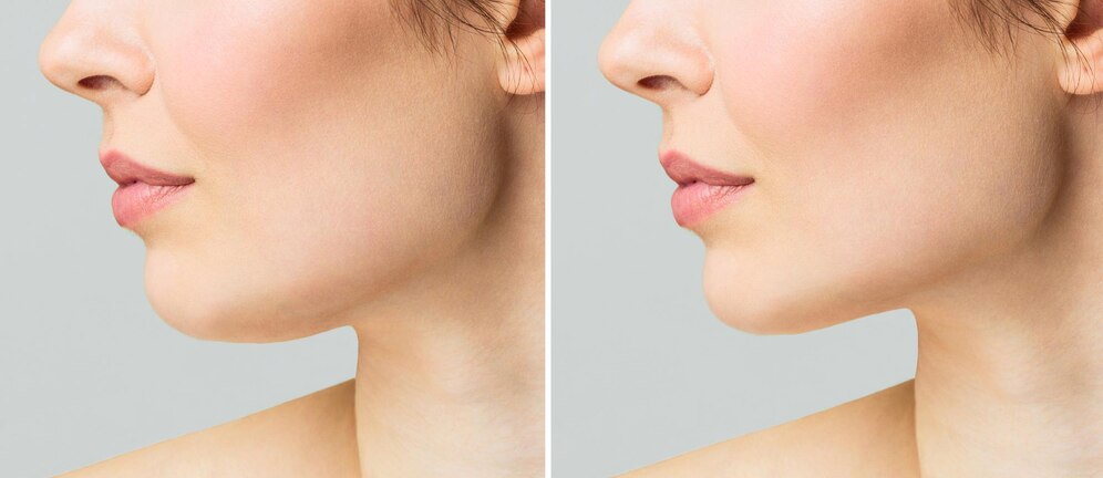Neck Lift Cost