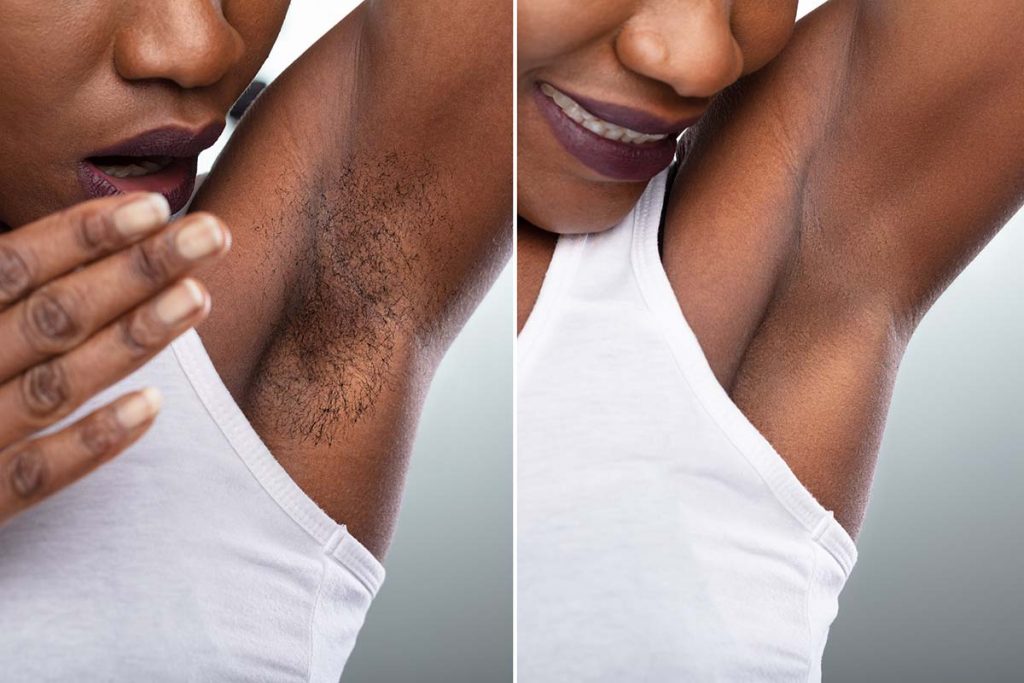 Laser Hair Removal For Dark Skin