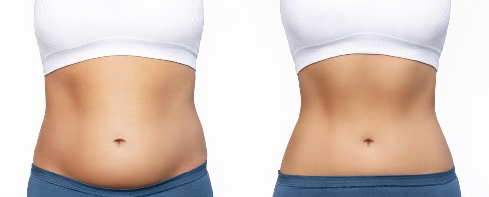 Tummy Tuck Before And After