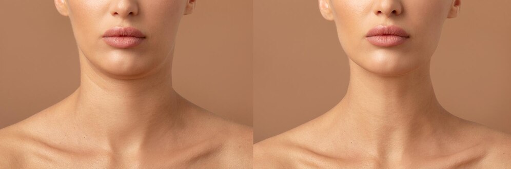 Neck Lift Cost