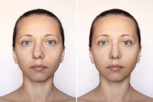 Mini Face Lift Before And After