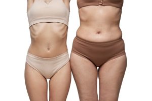 Tummy Tuck Before And After
