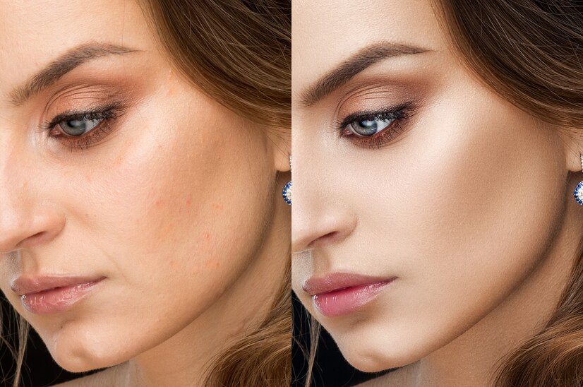 Skin Lightening Laser Treatment Before and After