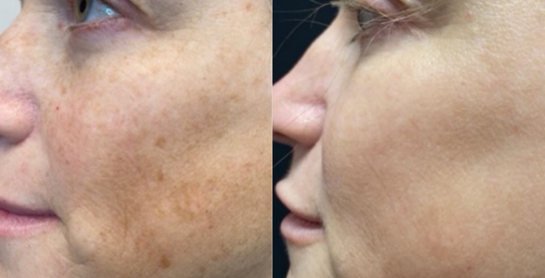Vitamin D Injections