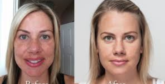 Vitamin D Injections