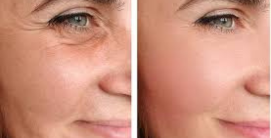 Non-Surgical Face Lift