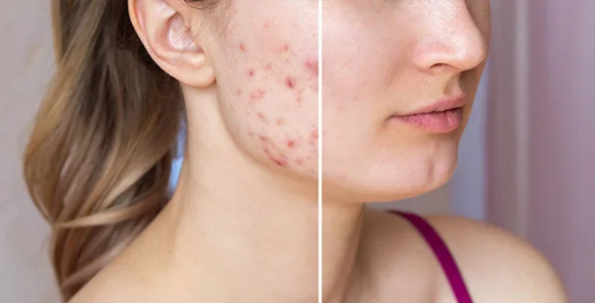 Skin Laser Treatment Machine