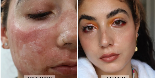 Skin Laser Treatment Machine