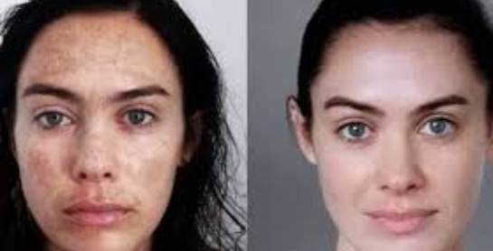 Skin Laser Treatment Machine