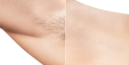 Hair Removal