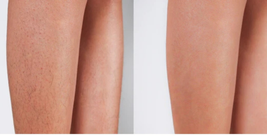 Hair Removal