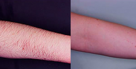 Hair Removal