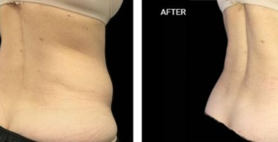 Body Contouring New York