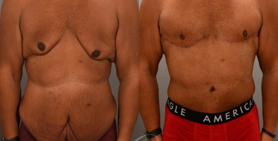 Body Contouring New York