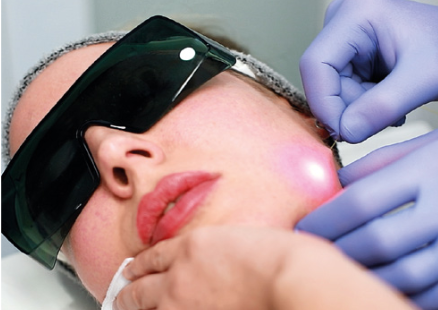 endolift2