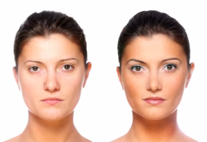 deep plane facelift