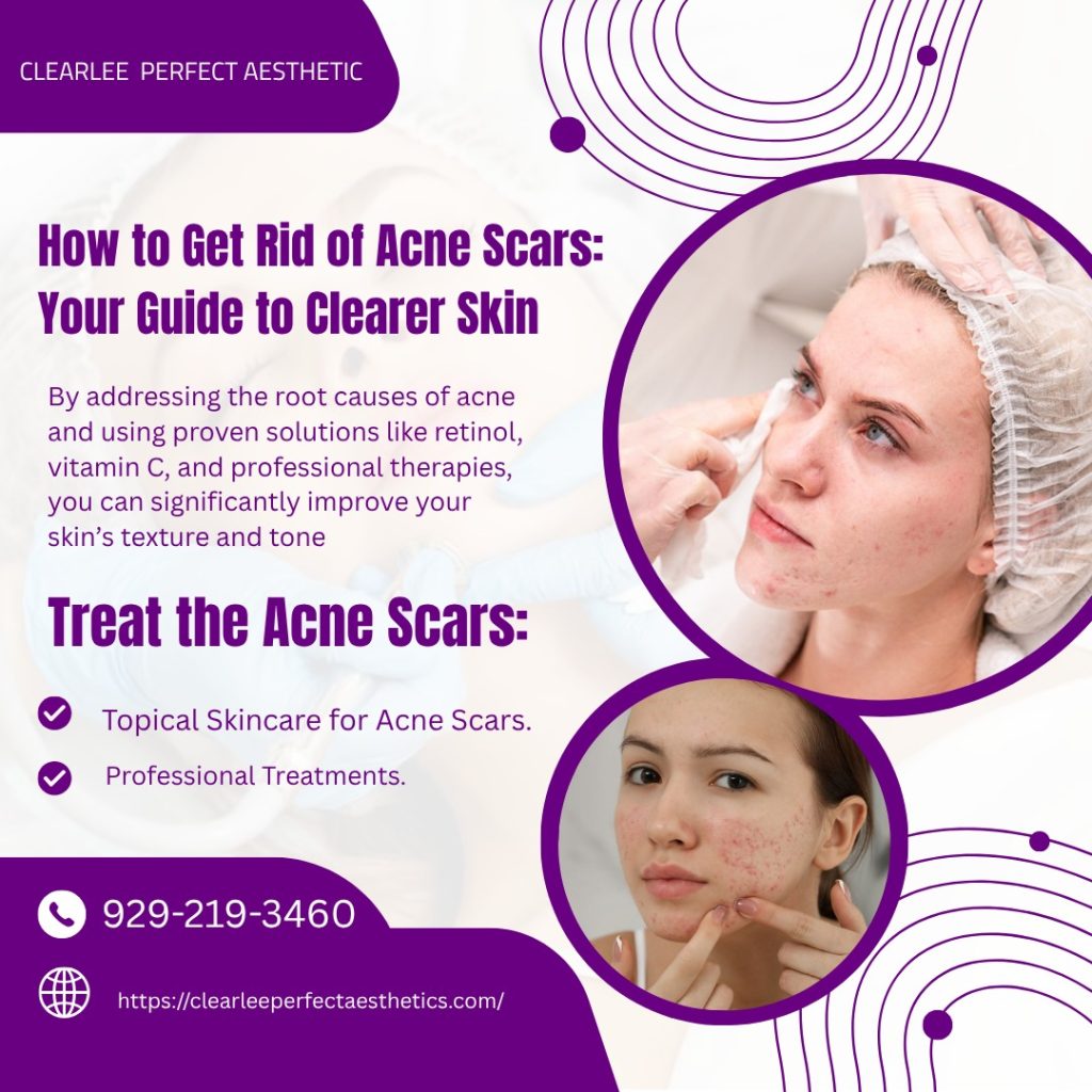 How to Get Rid of Acne Scars