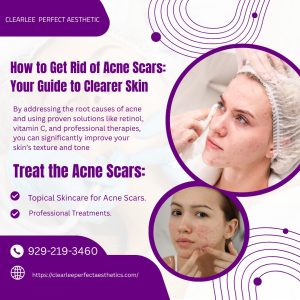 How to Get Rid of Acne Scars