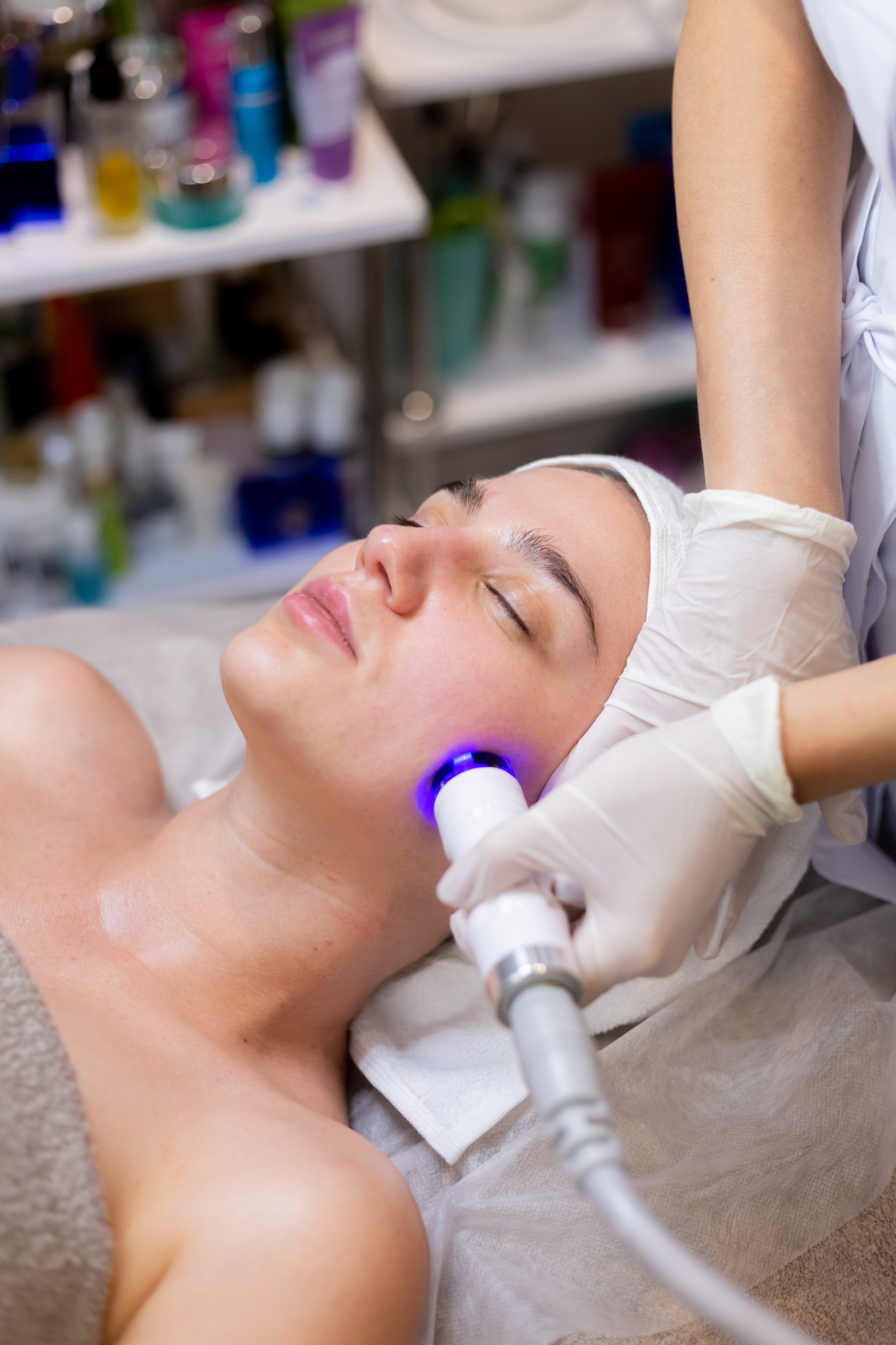 Photofacial vs Chemical Peel