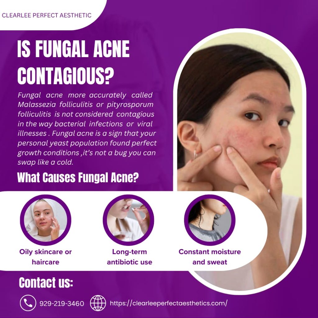 is fungal acne contagious​?