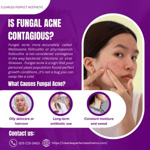 is fungal acne contagious​?
